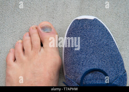 uncomfortable shoes. nail fungus. healthy feet. finger disease ...