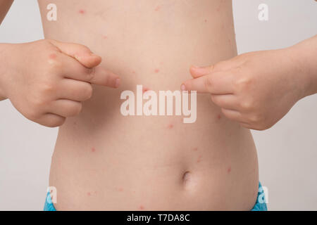 Baby with chicken pox rash. Varicella virus or Chickenpox bubble rash on child. Dermatology concept. Toddler shows blemishes on his belly Stock Photo