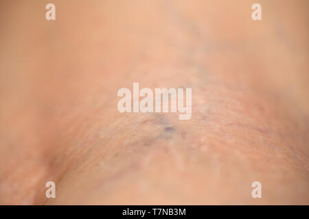 Extreme close up picture of spider veins on female leg. Expanded blood vessels Stock Photo