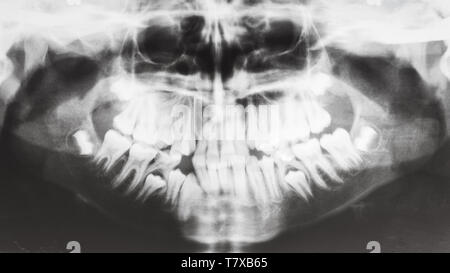 front view of human jaws on X-ray image Stock Photo