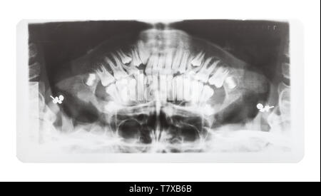 film with X-ray image of human jaws isolated on white background Stock Photo