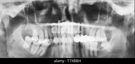 front view of human jaws with dental crown on teeth on X-ray image Stock Photo