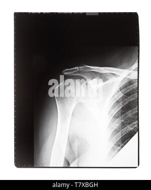 film with X-ray image of front view of human shoulder joint isolated on white background Stock Photo