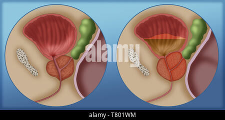 Comparison of normal prostate and enlarged prostate, Illustration Stock Photo
