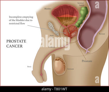 Prostate Cancer, Illustration Stock Photo