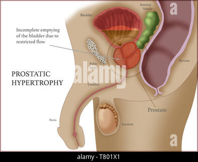Prostatic Hypertrophy, Enlarged Prostate,  Illustration Stock Photo