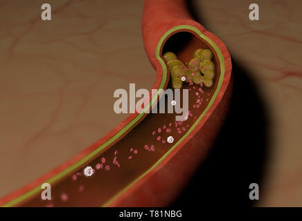 Clogged Artery, Illustration Stock Photo