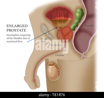 Enlarged Prostate, Illustration Stock Photo