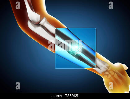 Broken arm, illustration Stock Photo