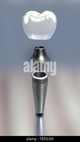 Dental implant, illustration Stock Photo