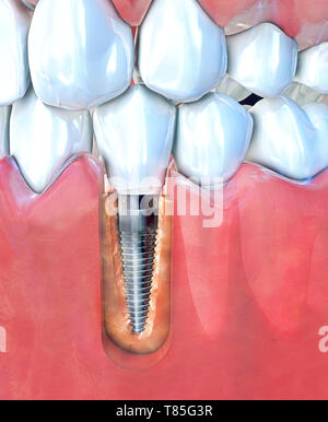 Dental implant, illustration Stock Photo