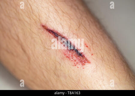 Deep gash on the leg of a young male person Stock Photo