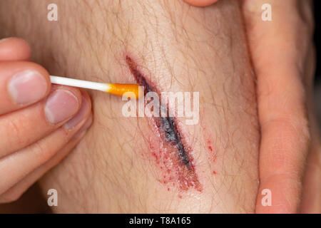 Deep gash on the leg of a young male person is getting disinfected with iodine Stock Photo