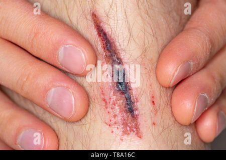 Deep gash on the leg of a young male person Stock Photo