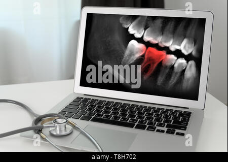 Dentist dental tool to teeth x-ray work Looking At Teeth X-ray On Computer Stock Photo