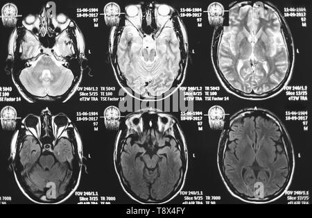 Magnetic resonance image of head. X-ray, MRI, brain, medicine, science Stock Photo