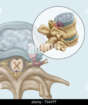 An illustration of the herniation of an intervertebral disk in the lumbar spine. Individuals suffer from a herniated disk when the outer fibrous tissue of the disk, known as the anulus fibrosus, can rupture due to trauma or old age. As a result, the gel-like center of the disk protrudes outward and compresses the nerves in the back, weakening muscles and causing severe local back pain. Stock Photo