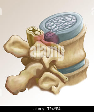 An illustration of the herniation of an intervertebral disk in the lumbar spine. Individuals suffer from a herniated disk when the outer fibrous tissue of the disk, known as the anulus fibrosus, can rupture due to trauma or old age. As a result, the gel-like center of the disk protrudes outward and compresses the nerves in the back, weakening muscles and causing severe local back pain. Stock Photo