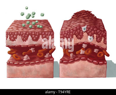 Illustration of healthy skin coming into contact with allergens (on the left) and the reaction that follows infection (on the right): dilation of blood vessels and the immune reaction of macrophages and lymphocytes that migrate to the inflammation, followed by the epidermis swelling (edema) and shedding of the upper epithelial cells.
