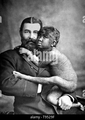William Leonard Hunt (June 10, 1838 - January 17, 1929) was a Canadian funambulist, entertainment promoter and inventor. Krao Farini (1876 - April 16, 1926) was an American sideshow performer born with hypertrichosis. It is claimed that in January 1881, Krao and her parents were captured in Laos during an expedition conducted by the explorer Carl Bock. An anthropologist, George Shelly, was part of the expedition and took charge of Krao. Stock Photo