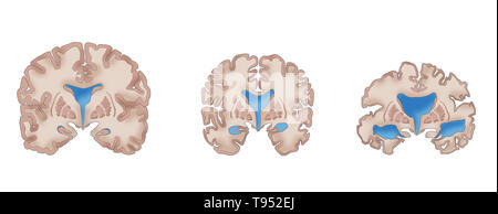 Illustration depicting the progression of Alzheimer's disease. On the ...