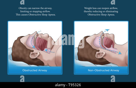 An illustration comparing an obese and normal sleeper. In adults, sleep  apnea is commonly caused by excess weight and obesity. During sleep, when  the throat and tongue muscles are more relaxed, soft