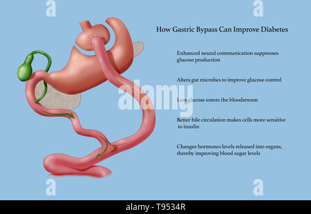 Roux-en-Y (RNY) gastric bypass is a weight loss surgery, or bariatric surgery, that is performed on patients who have tried and failed to lose weight losing using traditional methods. In Roux-en-Y gastric bypass, a small pouch at the top of the stomach is the only part of it that receives food, limiting intake. The small intestine is cut a short distance below the main stomach and connected to the new pouch. Food flows directly from the pouch into this part of the intestine. Stock Photo