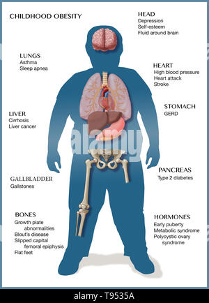 An illustration of the medical consequences of childhood obesity. Stock Photo