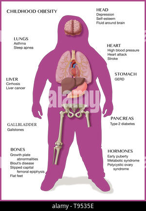 An illustration of the medical consequences of childhood obesity. Stock Photo