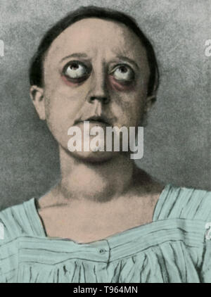 An historical illustration of a patient with Graves' ophthalmopathy (also known as Graves' Disease, Graves' thyroid-associated, or dysthyroid orbitopathy), an autoimmune inflammatory disorder affecting the orbit of the eye, with or without thyroid disorder. Stock Photo