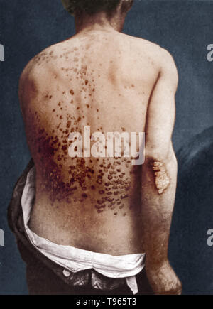 Guttate psoriasis on the back and arm of a man, photographed by George Henry Fox, 1886. Guttate psoriasis is a skin disease that takes the form of small lesions on the skin. It is usually the result of a bacterial infection. The word guttate is derived from the Latin word gutta, meaning drop. Stock Photo