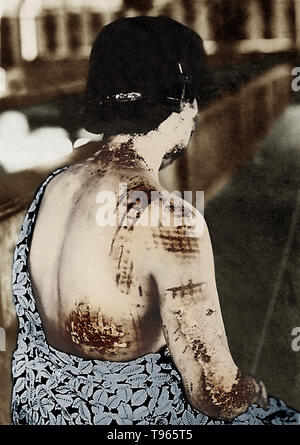 On August 6, 1945, near the end of World War II, the United States dropped an atomic bomb on the Japanese city of Hiroshima, destroying the city and killing over 70,000 people. In this image from a medical report of the bombing, the dark-colored pattern of a woman's clothes is shown to have absorbed thermal energy and burned the skin, particularly around more tight-fitting areas, such as the shoulders. Stock Photo