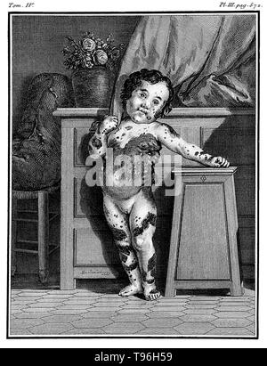 Comte de Buffon: Histoire Naturelle. Maria Herig, a girl with a skin disease identified as multiple fibroma. The Histoire Naturelle, générale et particulière, avec la description du Cabinet du Roi (Natural History, General and Particular, with a Description of the King's Cabinet) is an encyclopedic collection of 36 large (quarto) volumes written between 1749-1804 by the Comte de Buffon, and continued in eight more volumes after his death by his colleagues. Stock Photo