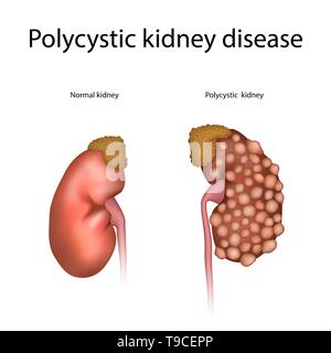 Polycystic kidney disease, illustration Stock Photo - Alamy