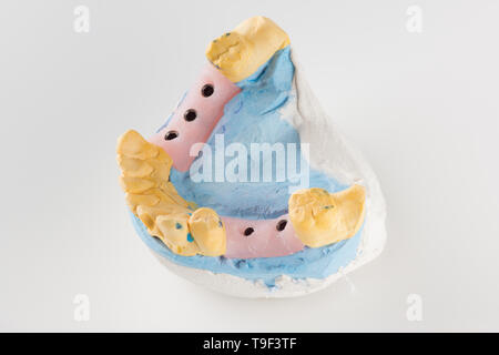 dental plaster model with artificial analogues of dental implants Stock Photo