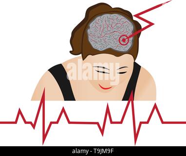 Stroke develope in human brains vecroe illustration Stock Vector