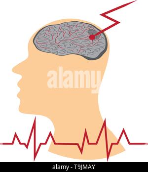 Stroke develope in human brains vecroe illustration Stock Vector