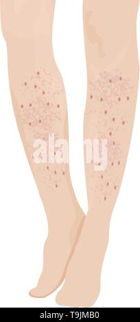 Psoriasis on human skin. Dermatological disease. The symptom is itching ...