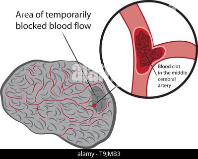 Stroke develope in human brains vecroe illustration Stock Vector