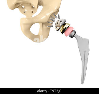 3D illustration of Hip replacement implant installed in the pelvis bone. Stock Photo