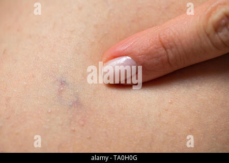 Close up picture of woman pointing at her painful varicose veins on the leg Stock Photo