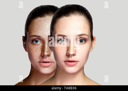 Closeup before and after portrait of beautiful brunette woman after laser treatment removing freckles on face looking at camera. makeup or cosmetology Stock Photo