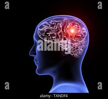 Headache migraine. Human x-ray profile with  brain, pain location highlighted in red. Isolated on black background. 3d render Stock Photo