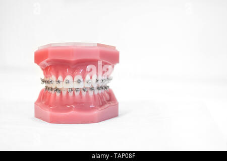 braces on teeth model  of orthodontic bracket or brace  - Stock Photo