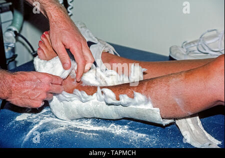 An orthopedic physician pulls apart the protective cotton lining inside the plaster cast that supported the broken ankle of a Caucasian woman while the fractured bone in her left leg was healing. Initially the plaster was perforated with a special electric-powered cast saw with an oscillating blade that vibrates instead of spinning, which prevents it from cutting the skin. The oscillating saw was patented for medical use in 1945 by an American orthopaedic surgeon, Dr. Homer Stryker, and is still the most common cast-cutting saw in use today. Stock Photo