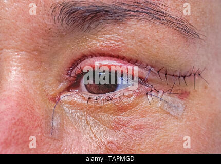 A close-up of the left eye of a Caucasian woman after cosmetic eyelid surgery shows the fine stitches used to avoid showing scars by suturing incisions with needle and thread. Also called blepharoplasty, eye lift surgery can remove excess skin from the upper eyelids (that may hinder vision) and reduce bagginess from lower eyelids. The procedure is a popular choice for facial plastic surgery when the skin loses its elasticity as a person ages. Stock Photo