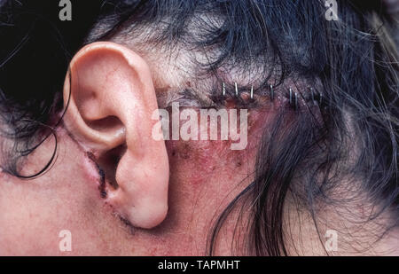 A close-up of the left side of a Caucasian woman's head a few weeks after a face-lift shows healing in progress following her cosmetic surgery. Fine stitches were used around the front part of her ear, while metal staples closed the skin under her hair. Using stainless steel surgical staples is faster than suturing an incision by hand with needle and thread, but stitches are preferred to avoid showing facial scars. The medical term for a face-lift is  rhytidectomy, a surgical procedure that is most often done to give the face a younger appearance. Stock Photo