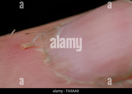 chapped skin around the nail close-up macro Stock Photo