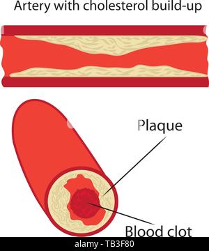 Levels of cholesterol plaque in vessels vector illustration Stock ...