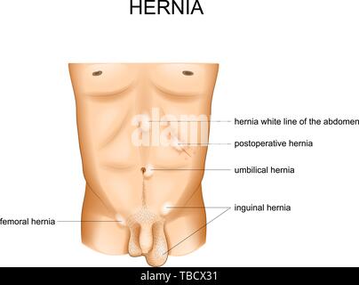 vector illustration of hernia types by location Stock Vector